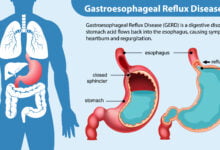 Mastering Esophageal Reflux Proven Strategies for Relief and Prevention in 2024